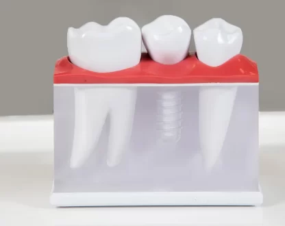 Are-Implants-Only-for-Older-Adults